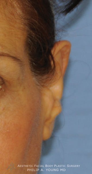 Ear Otoplasty Before & After Gallery - Patient 228295 - Image 4