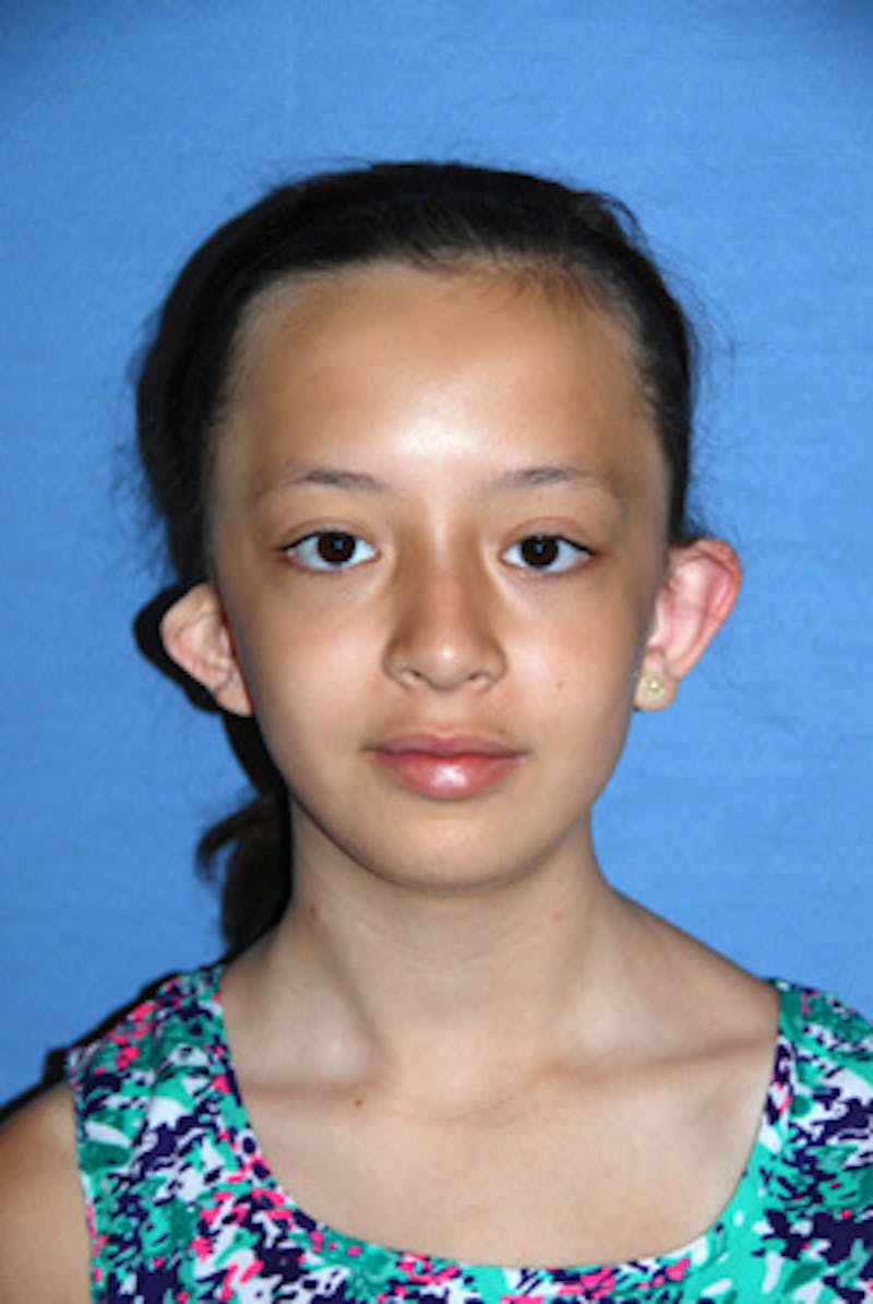 Ear Otoplasty Before & After Gallery - Patient 342966 - Image 1