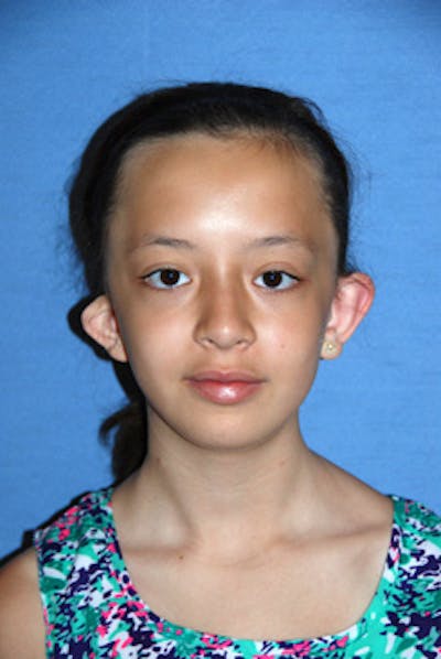Ear Otoplasty Before & After Gallery - Patient 342966 - Image 1