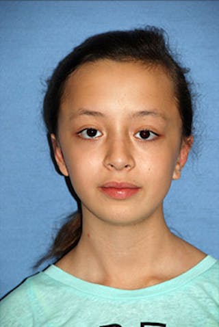 Ear Otoplasty Before & After Gallery - Patient 342966 - Image 2