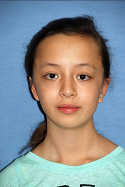 Ear Otoplasty Before & After Gallery - Patient 342966 - Image 2