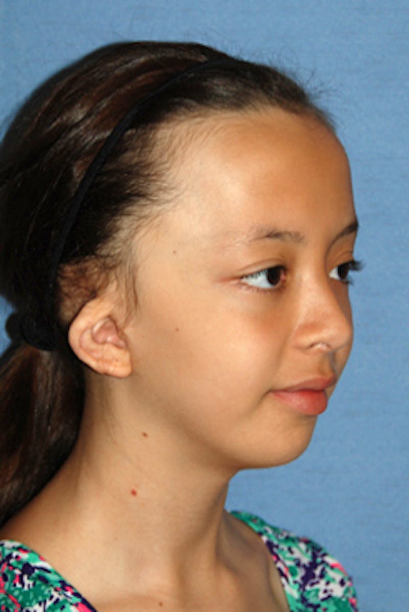 Ear Otoplasty Before & After Gallery - Patient 342966 - Image 3