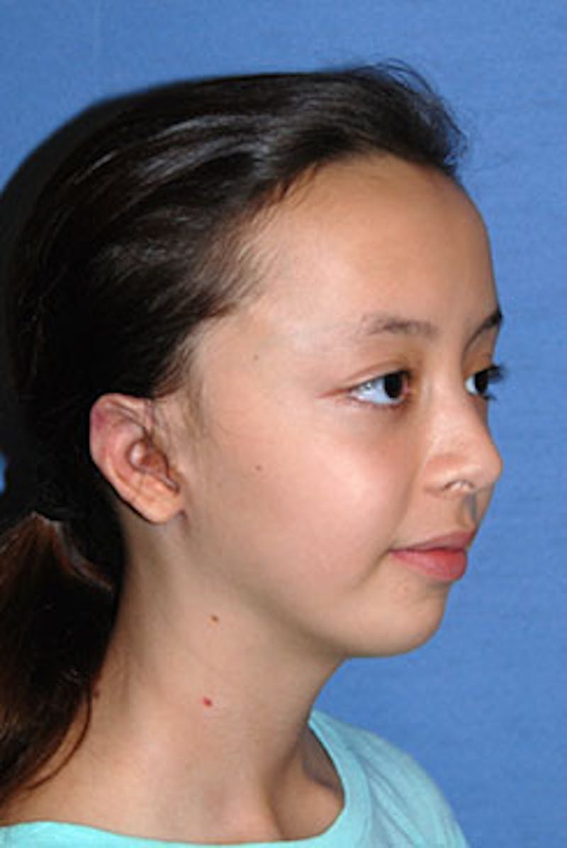Ear Otoplasty Before & After Gallery - Patient 342966 - Image 4