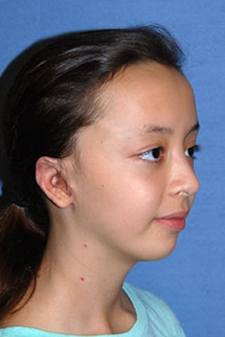Ear Otoplasty Before & After Gallery - Patient 342966 - Image 4