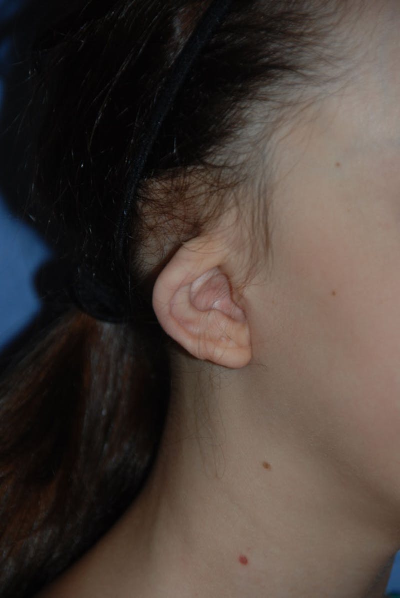 Ear Otoplasty Before & After Gallery - Patient 342966 - Image 5
