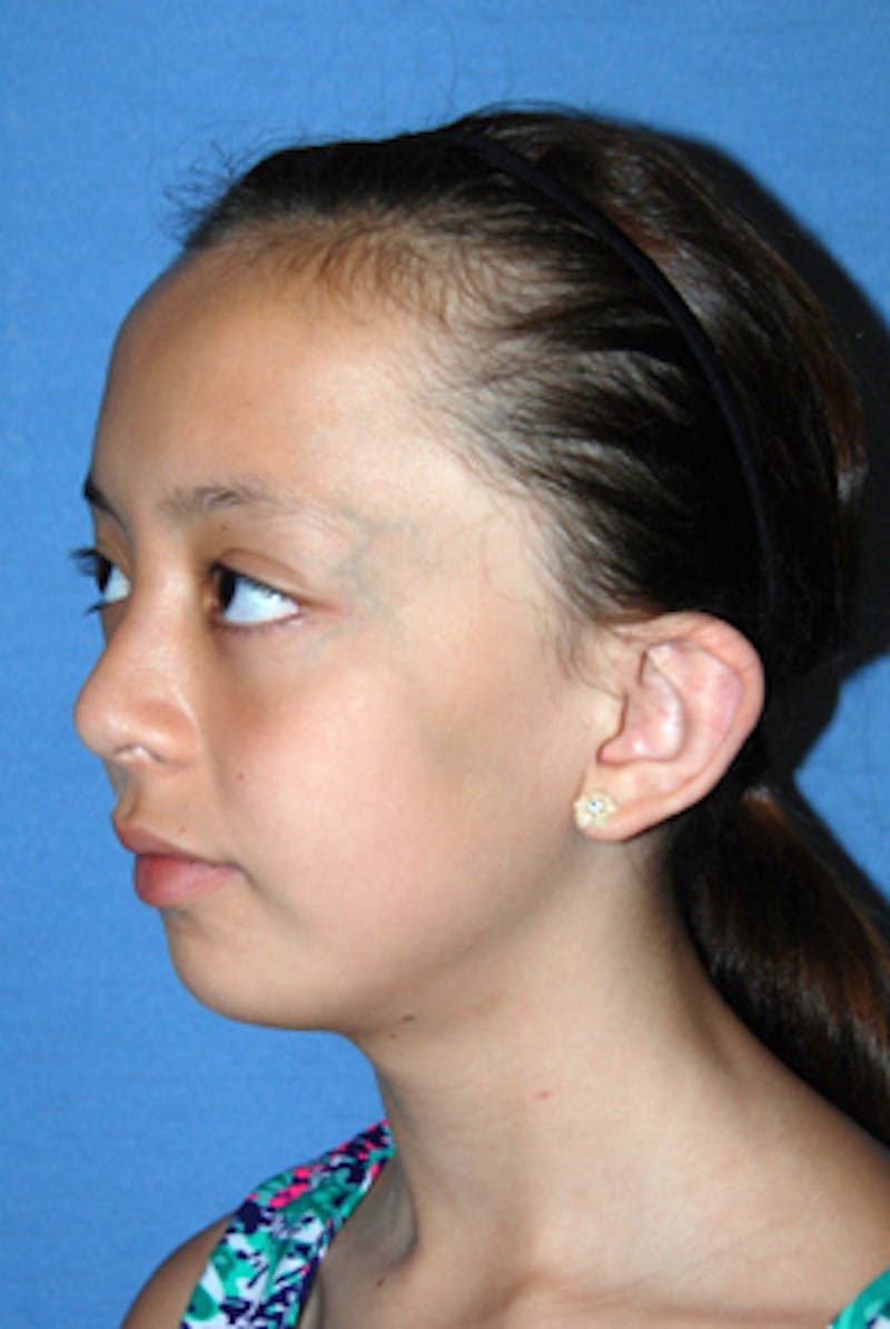 Ear Otoplasty Before & After Gallery - Patient 342966 - Image 7