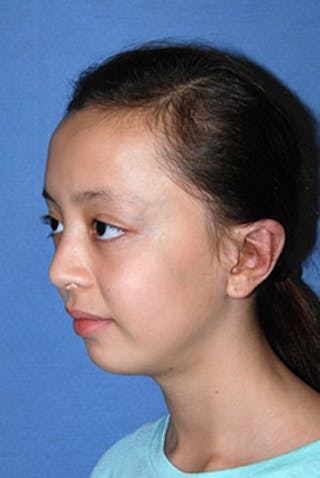 Ear Otoplasty Before & After Gallery - Patient 342966 - Image 8