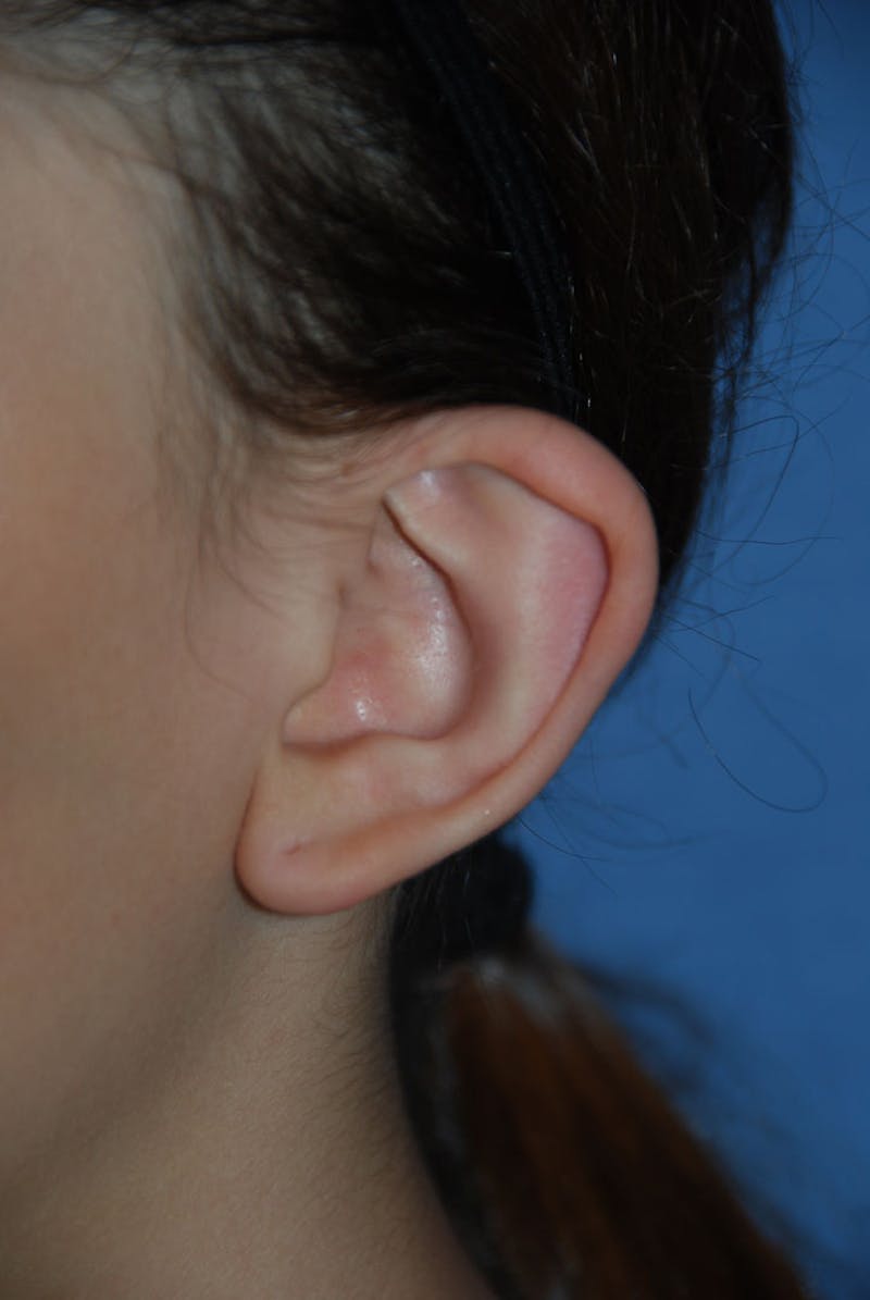 Ear Otoplasty Before & After Gallery - Patient 342966 - Image 9