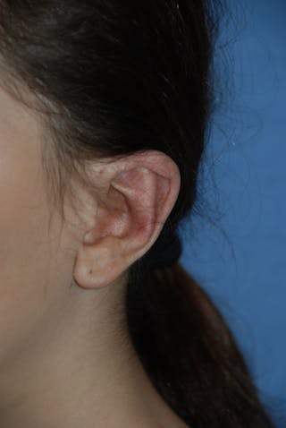 Ear Otoplasty Before & After Gallery - Patient 342966 - Image 10