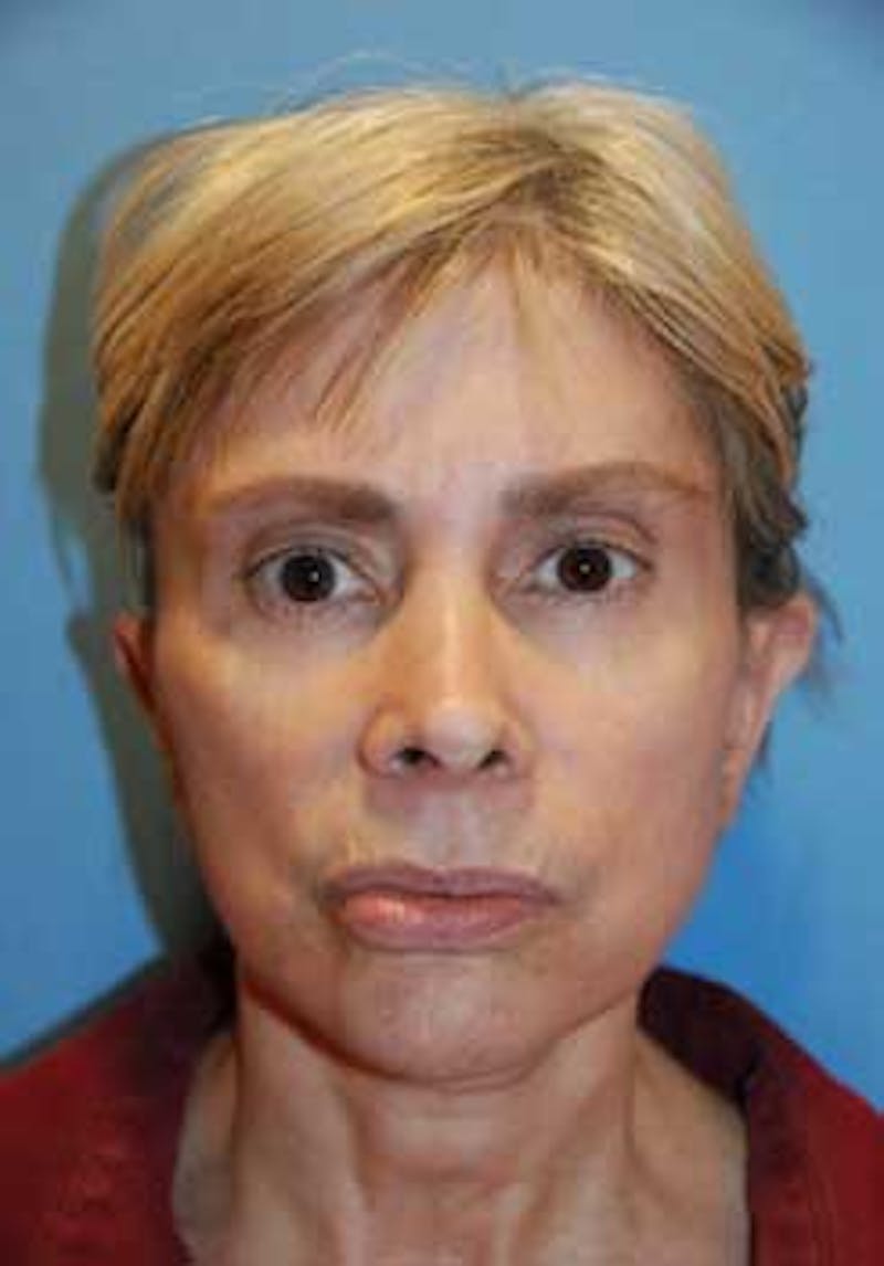Ear Otoplasty Before & After Gallery - Patient 403333 - Image 1