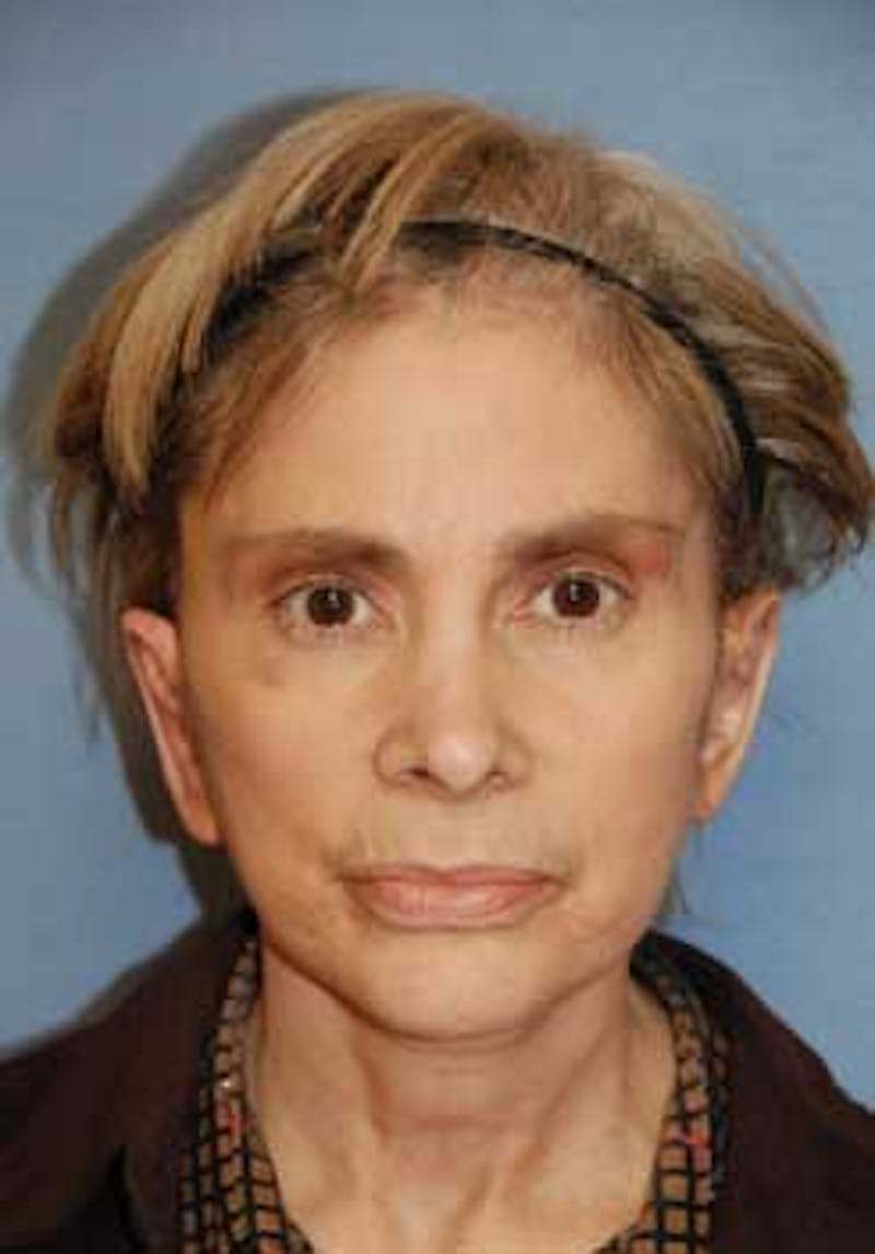 Ear Otoplasty Before & After Gallery - Patient 403333 - Image 2