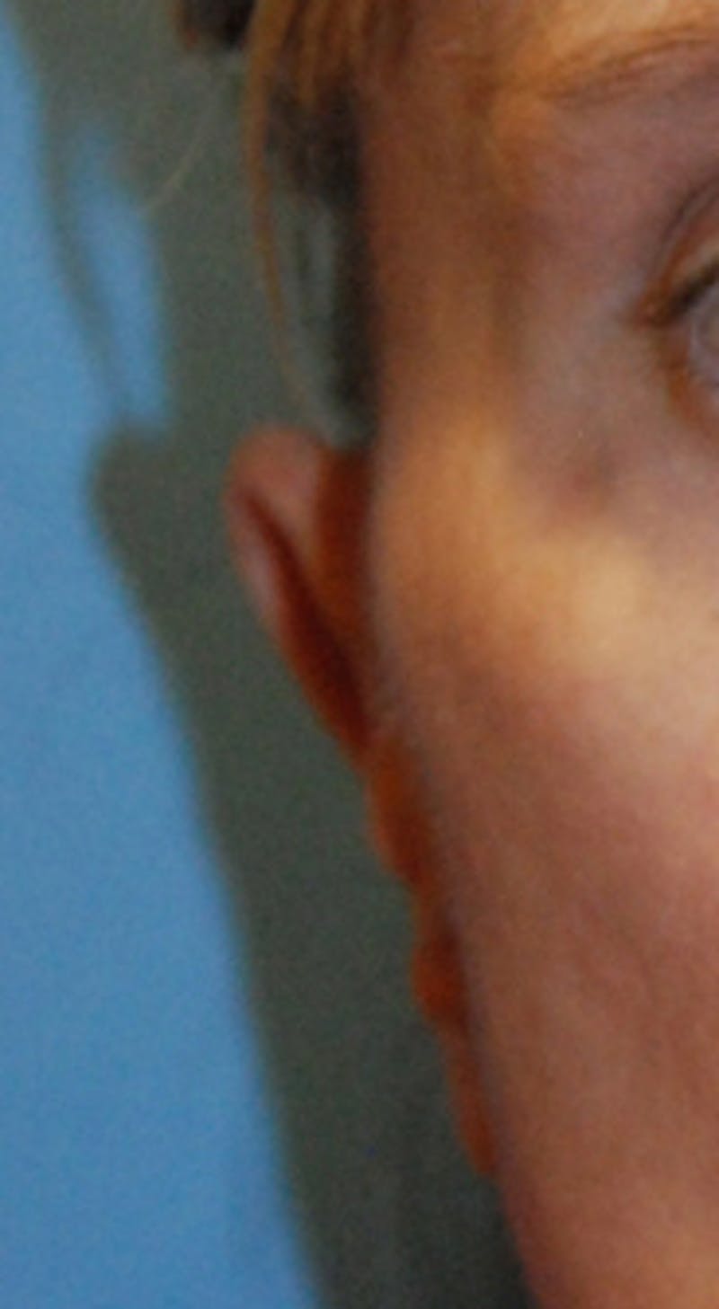 Ear Otoplasty Before & After Gallery - Patient 310028 - Image 1
