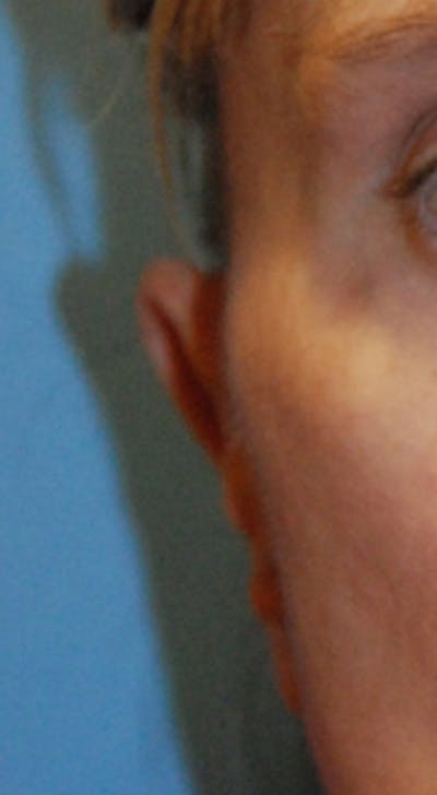 Ear Otoplasty Before & After Gallery - Patient 310028 - Image 1