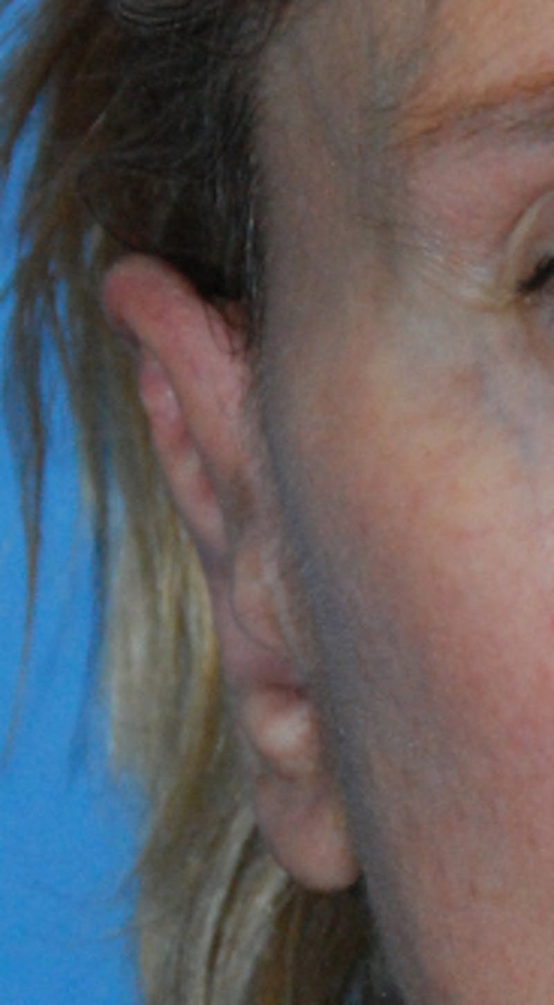 Ear Otoplasty Before & After Gallery - Patient 310028 - Image 2