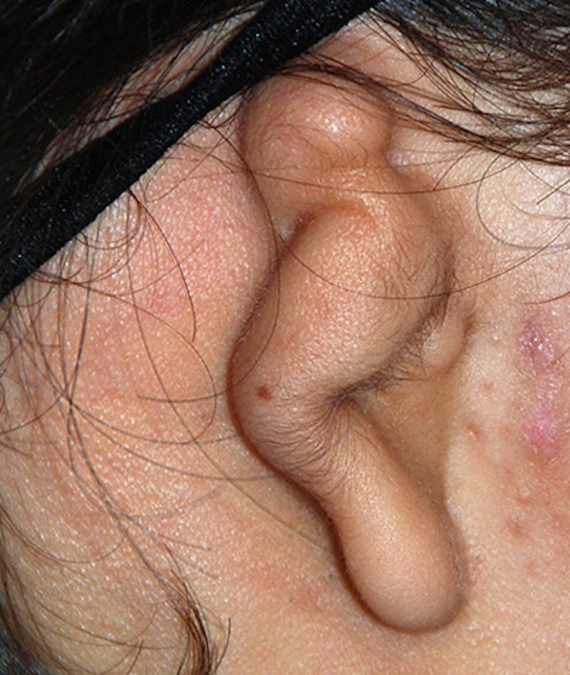Ear Otoplasty Before & After Gallery - Patient 403947 - Image 1