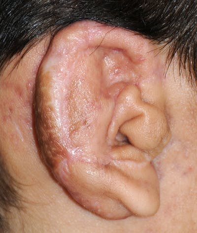 Ear Otoplasty Before & After Gallery - Patient 403947 - Image 2