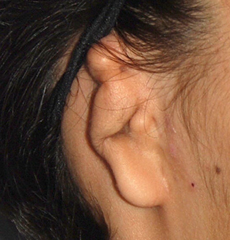 Ear Otoplasty Before & After Gallery - Patient 403947 - Image 3