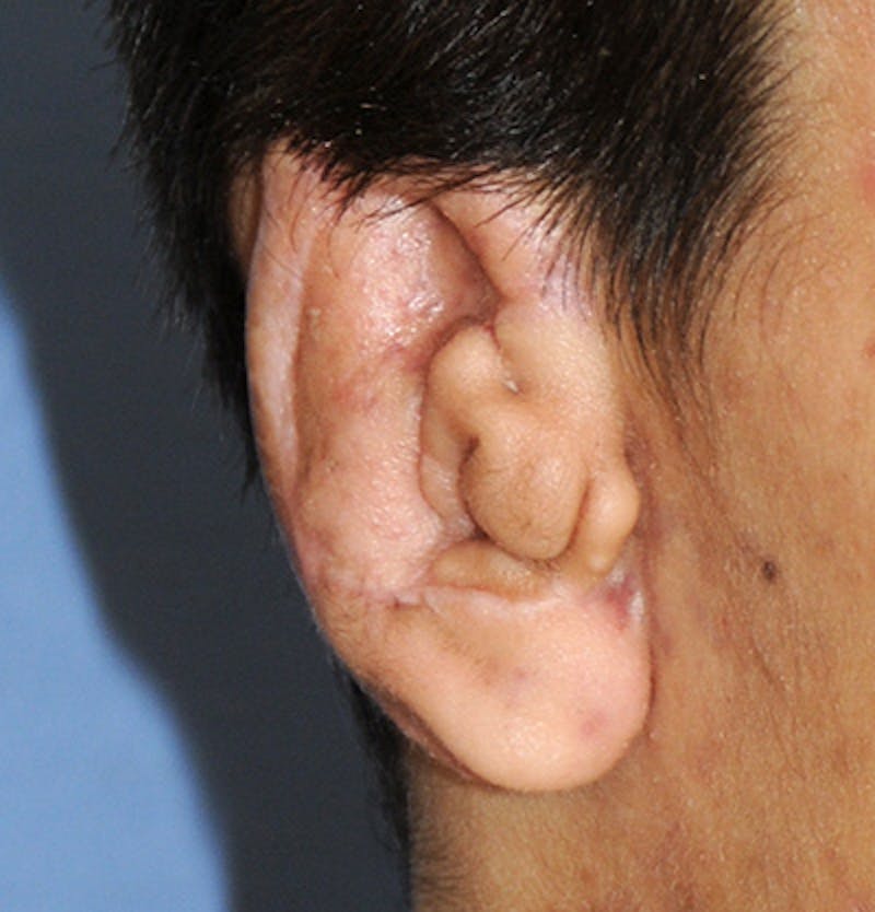Ear Otoplasty Before & After Gallery - Patient 403947 - Image 4
