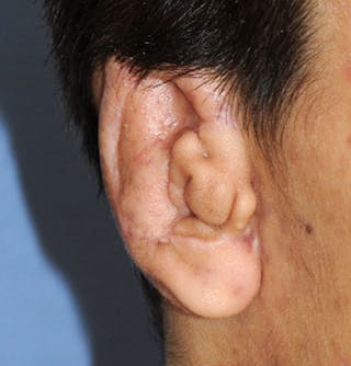 Ear Otoplasty Before & After Gallery - Patient 403947 - Image 4