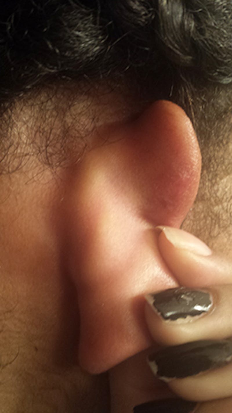 Ear Otoplasty Before & After Gallery - Patient 192017 - Image 2
