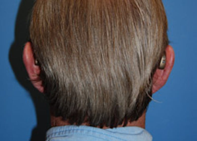 Ear Otoplasty Before & After Gallery - Patient 157505 - Image 1