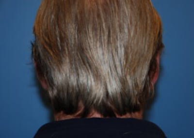 Ear Otoplasty Before & After Gallery - Patient 157505 - Image 2