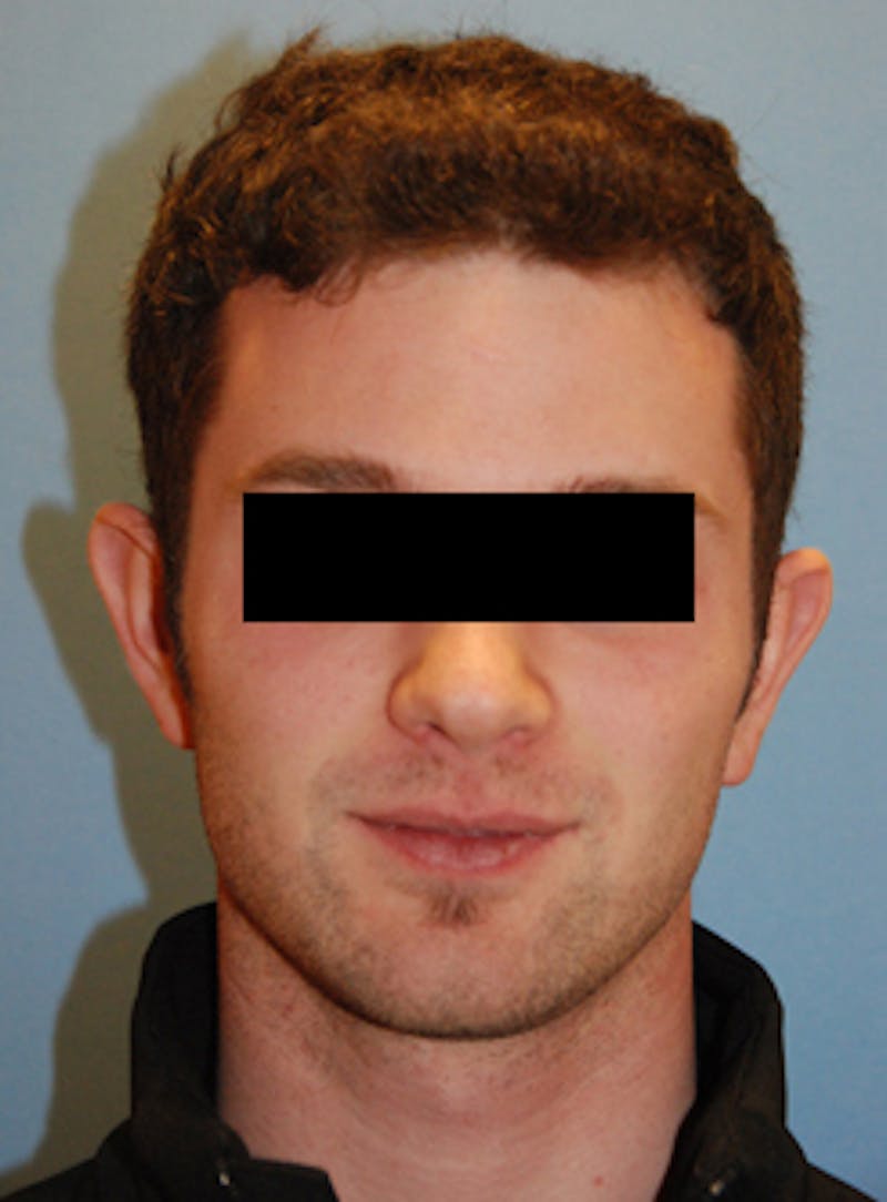Ear Otoplasty Before & After Gallery - Patient 114603 - Image 1