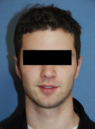 Ear Otoplasty Before & After Gallery - Patient 114603 - Image 2