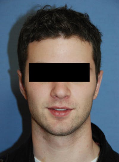 Ear Otoplasty Before & After Gallery - Patient 114603 - Image 2