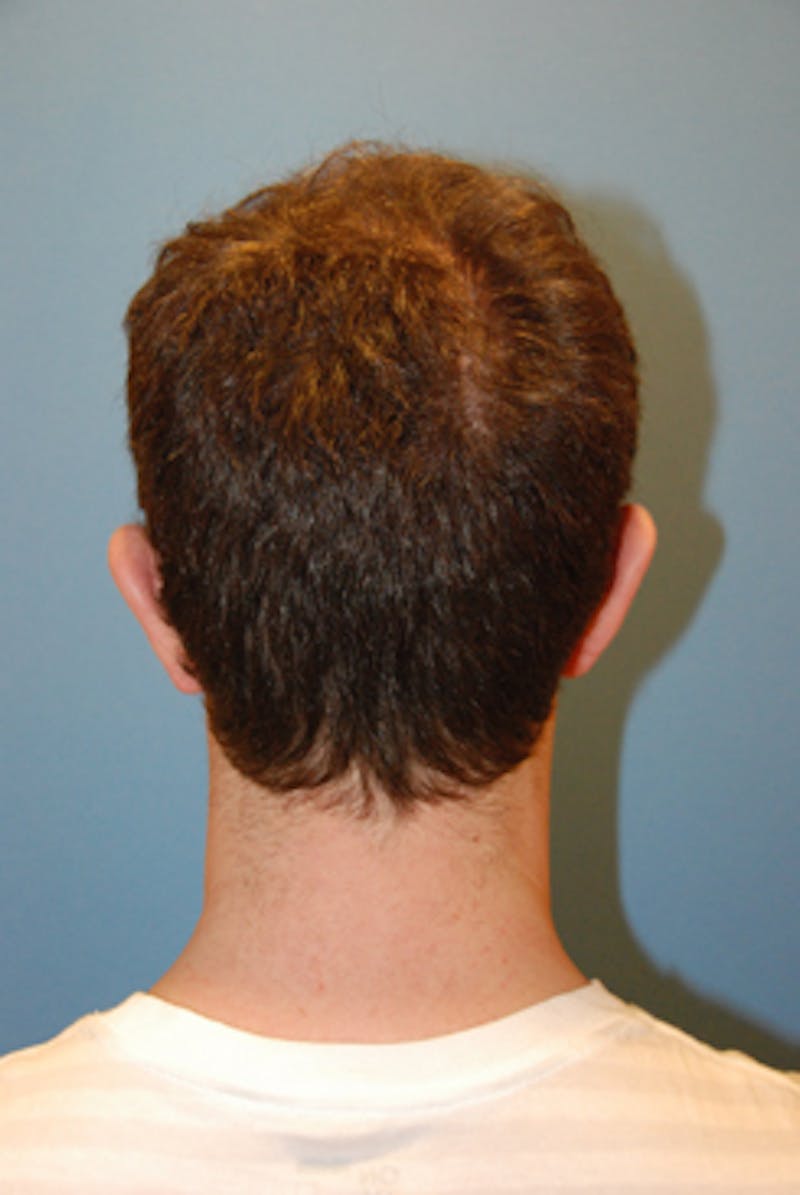 Ear Otoplasty Before & After Gallery - Patient 114603 - Image 3