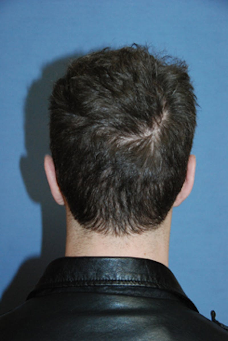 Ear Otoplasty Before & After Gallery - Patient 114603 - Image 4