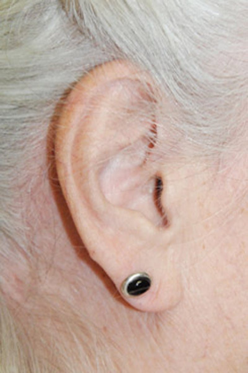 Ear Otoplasty Before & After Gallery - Patient 424778 - Image 1