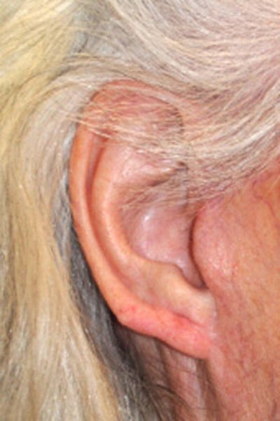 Ear Otoplasty Before & After Gallery - Patient 424778 - Image 2