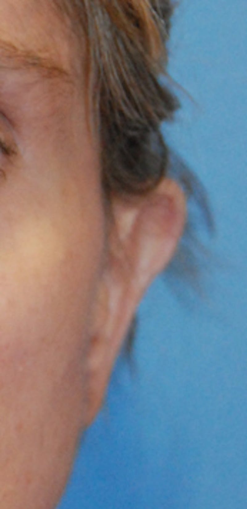 Ear Otoplasty Before & After Gallery - Patient 311409 - Image 1