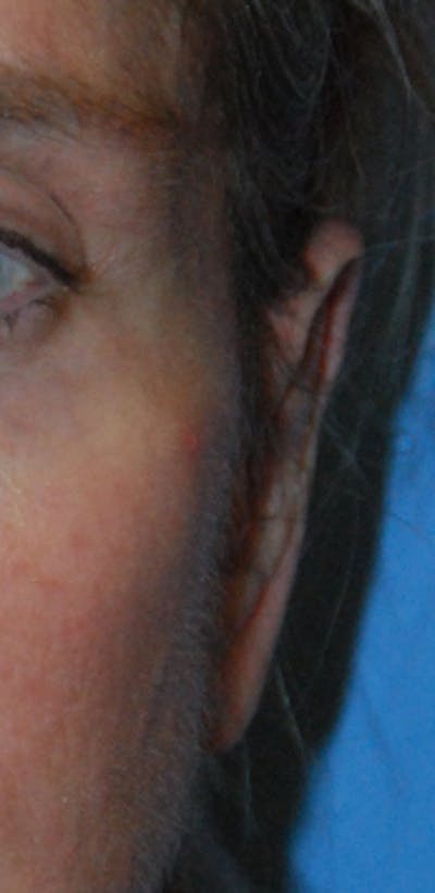 Ear Otoplasty Before & After Gallery - Patient 311409 - Image 2