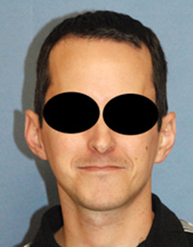 Ear Otoplasty Before & After Gallery - Patient 410123 - Image 1