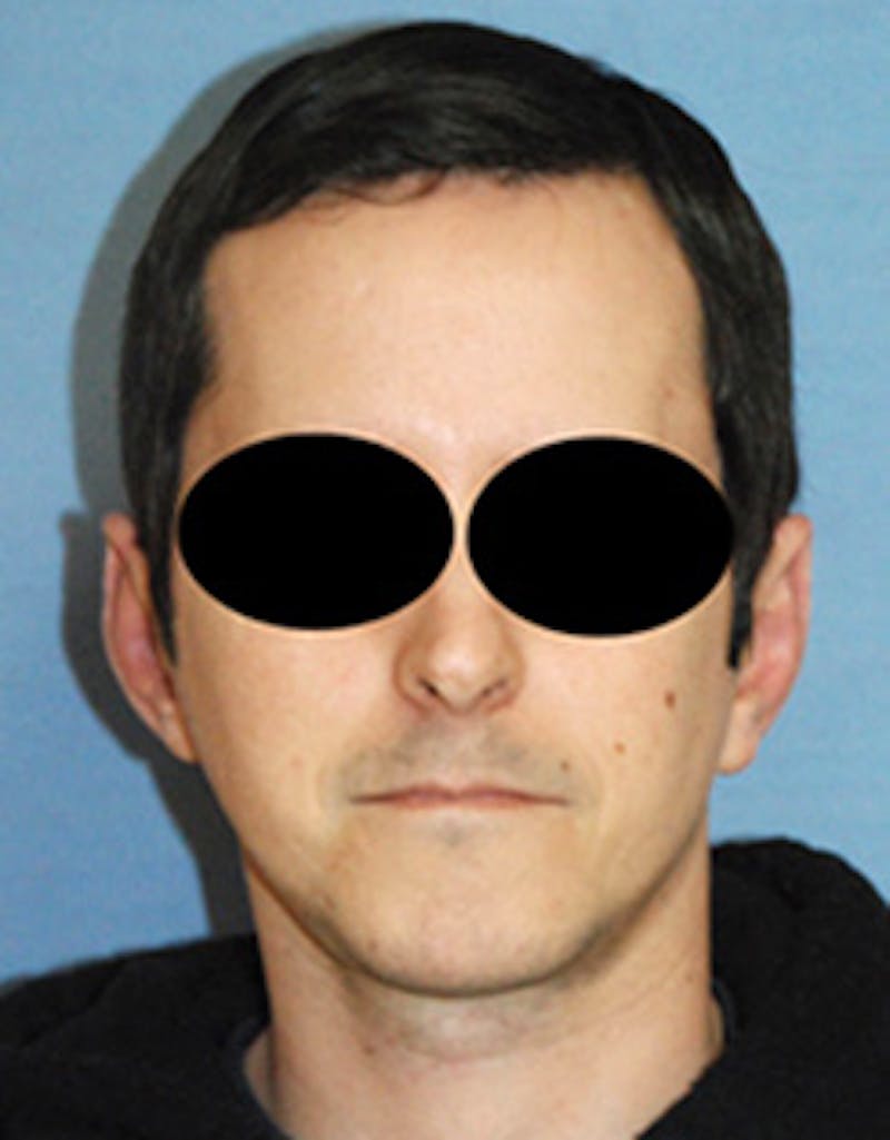 Ear Otoplasty Before & After Gallery - Patient 410123 - Image 2