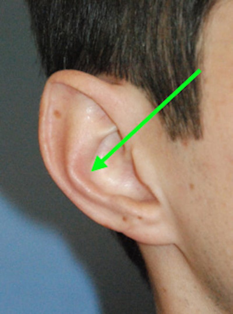 Ear Otoplasty Before & After Gallery - Patient 410123 - Image 3