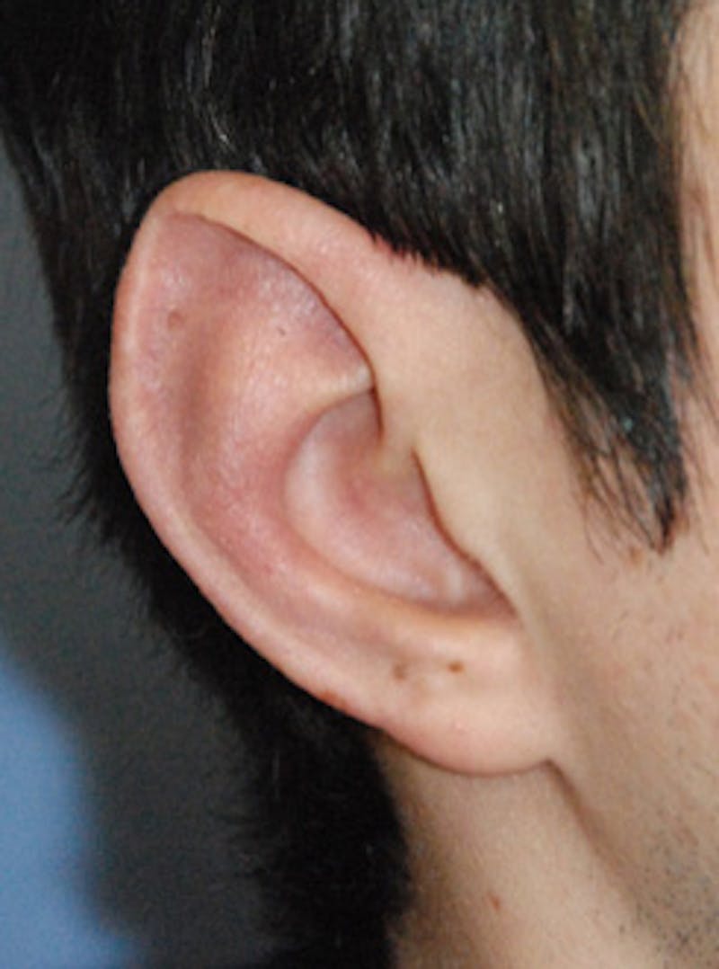Ear Otoplasty Before & After Gallery - Patient 410123 - Image 4