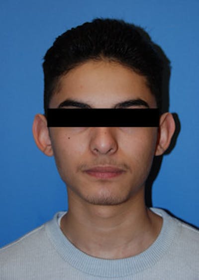Ear Otoplasty Before & After Gallery - Patient 694406 - Image 1