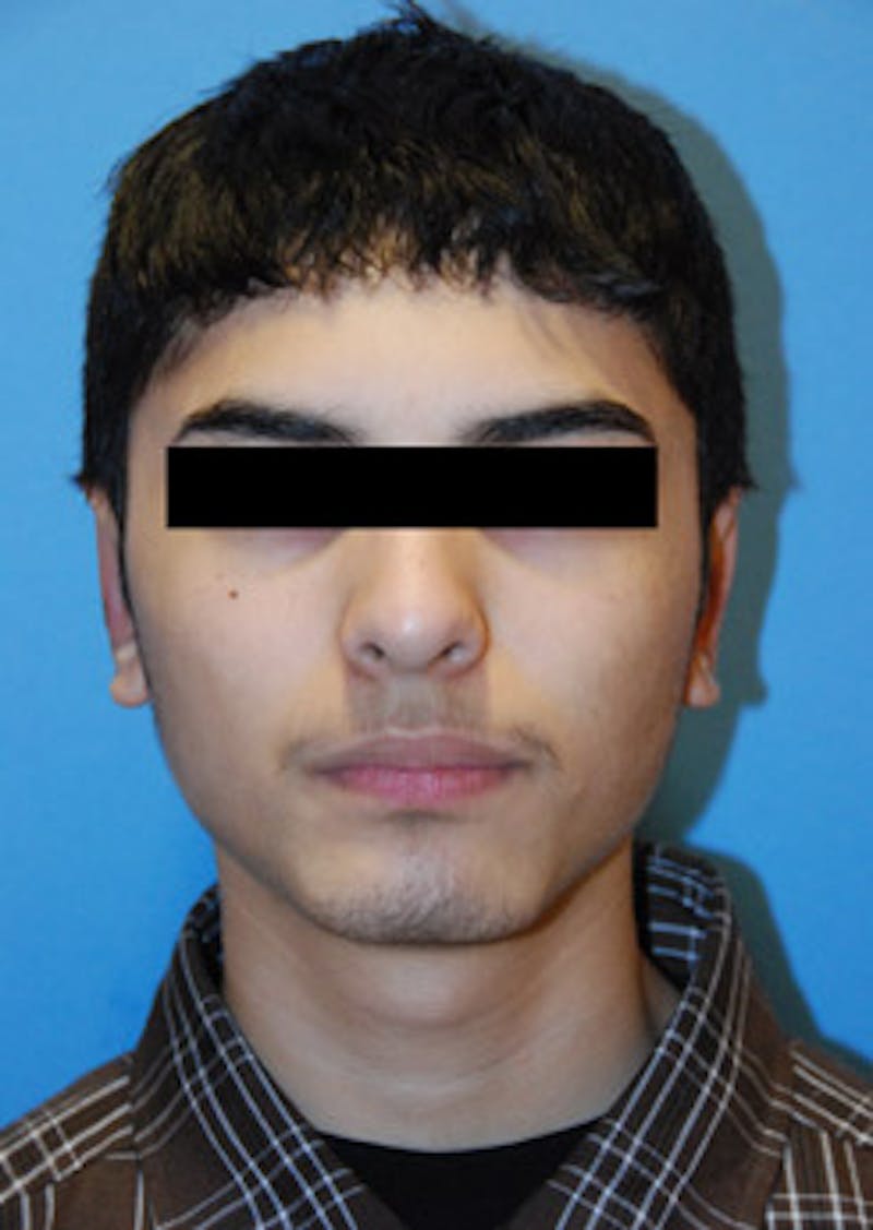 Ear Otoplasty Before & After Gallery - Patient 694406 - Image 2