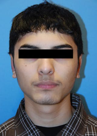 Ear Otoplasty Before & After Gallery - Patient 694406 - Image 2