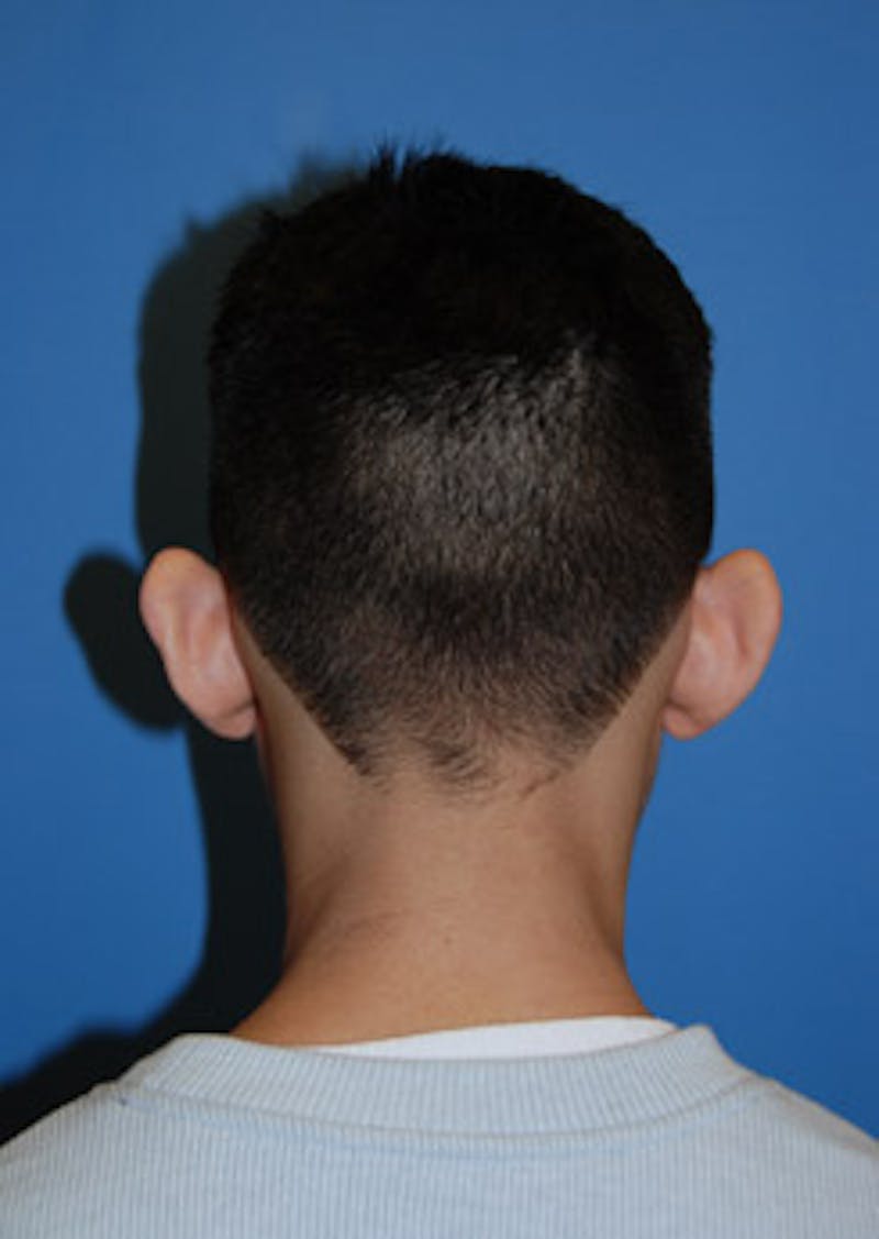 Ear Otoplasty Before & After Gallery - Patient 694406 - Image 3