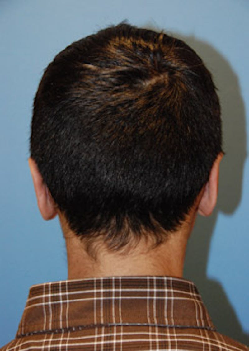 Ear Otoplasty Before & After Gallery - Patient 694406 - Image 4
