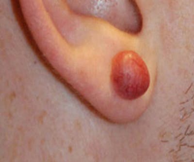 Ear Otoplasty Before & After Gallery - Patient 396082 - Image 1