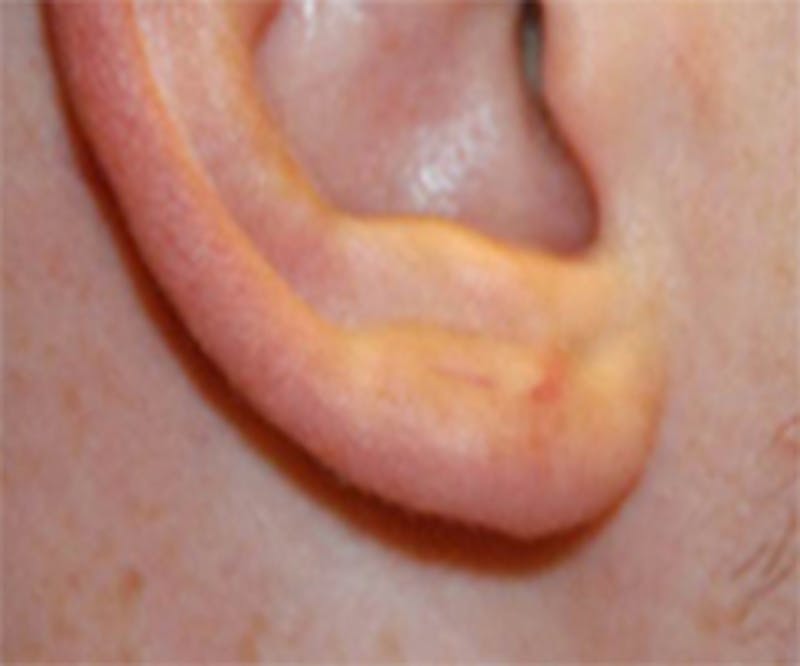 Ear Otoplasty Before & After Gallery - Patient 396082 - Image 2