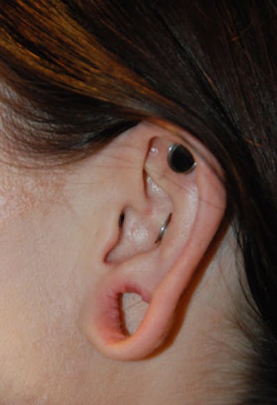 Ear Otoplasty Before & After Gallery - Patient 388279 - Image 1