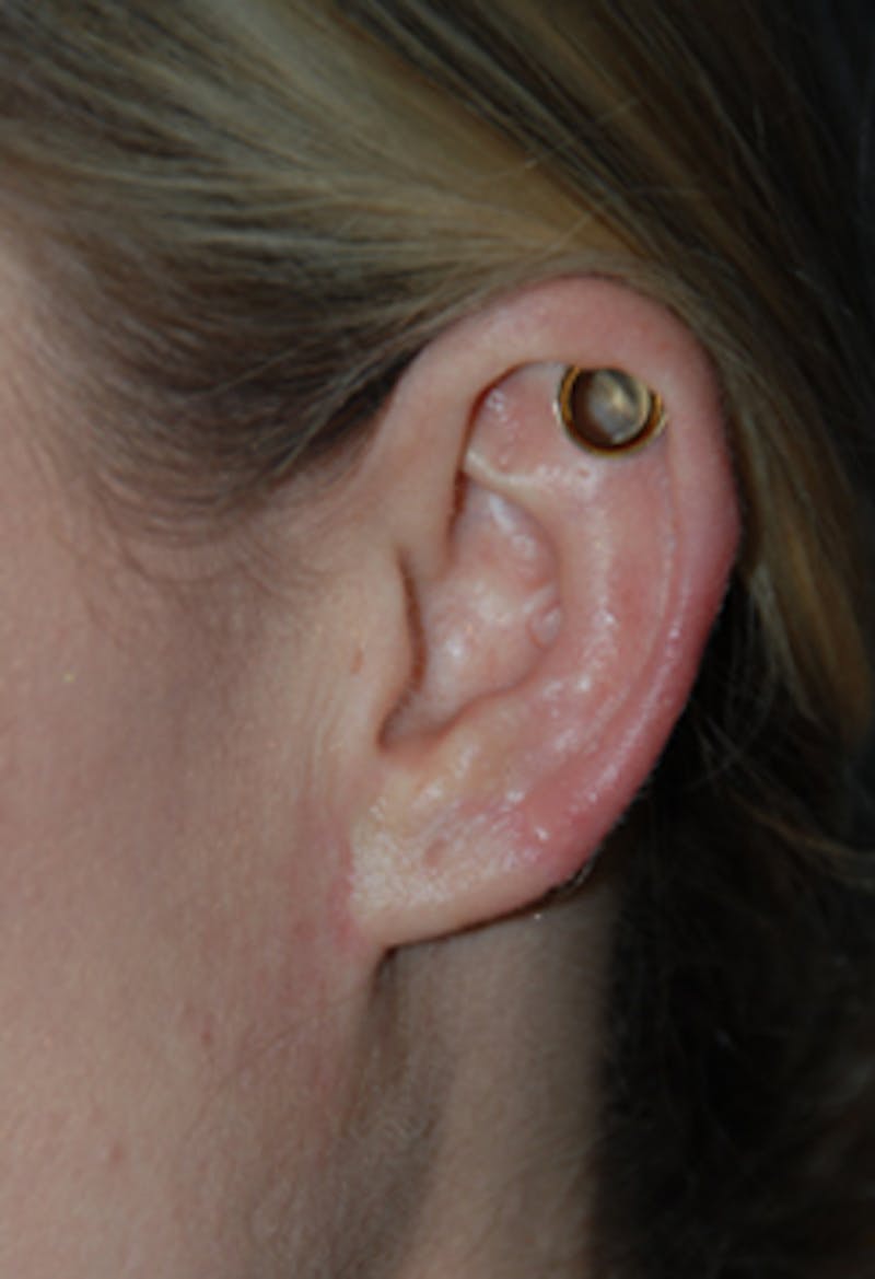 Ear Otoplasty Before & After Gallery - Patient 388279 - Image 2