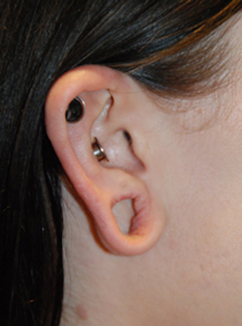 Ear Otoplasty Before & After Gallery - Patient 388279 - Image 3
