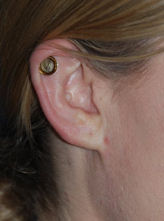 Ear Otoplasty Before & After Gallery - Patient 388279 - Image 4